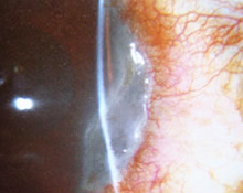 蛋食性角膜潰瘍