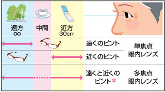 眼内レンズの種類